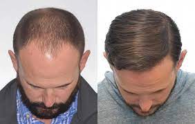 What Does Hair Transplant Cost? A Complete Breakdown